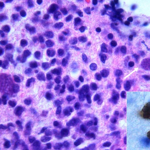 Histologická a imunohistochemická detekce pseudocyst u mozkové toxoplazmózy v mozkové biopsii u imunokompromitovaného pacienta. (c) Wikipedia