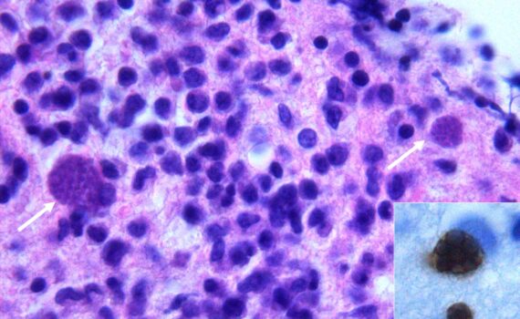 Histologická a imunohistochemická detekce pseudocyst u mozkové toxoplazmózy v mozkové biopsii u imunokompromitovaného pacienta. (c) Wikipedia